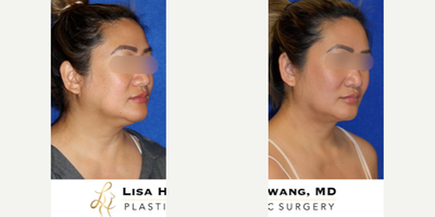 Buccal Fat Removal before and after photo