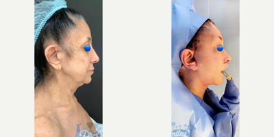 Facelift before and after photo