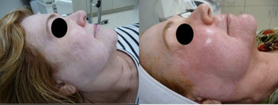 Fractora RF before and after photo