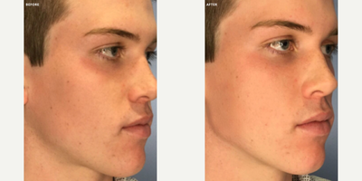 Juvederm before and after photo