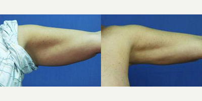 Liposuction before and after photo