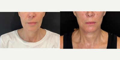 Neck Lift before and after photo