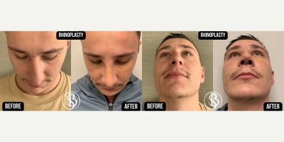 Rhinoplasty before and after photo