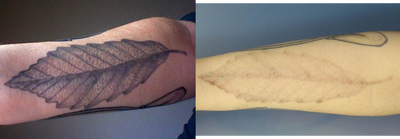 Tattoo Removal before and after photo