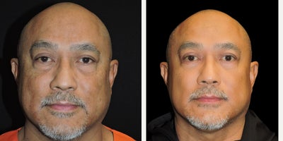 Eyelid Surgery before and after photo