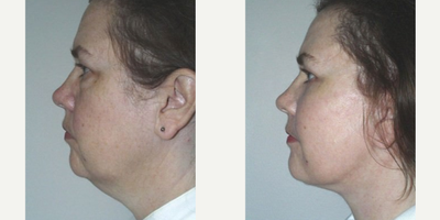 Facelift before and after photo