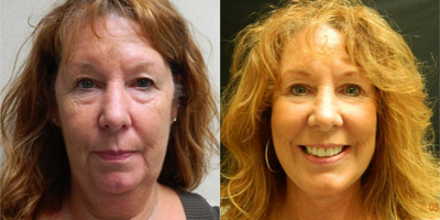 Facelift before and after photo