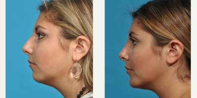 Genioplasty before and after photo