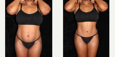 Mommy Makeover before and after photo
