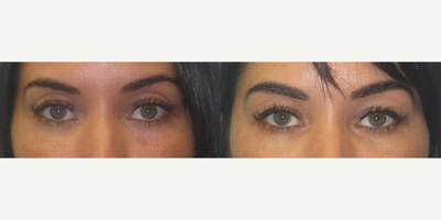 Restylane before and after photo