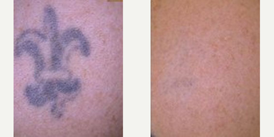 Tattoo Removal before and after photo