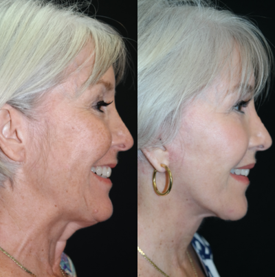 Lower Facelift before and after photo
