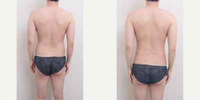Smart Lipo before and after photo