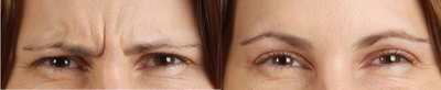 Botox before and after photo