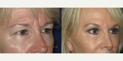 Brow Lift before and after photo