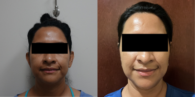 Ear Surgery before and after photo
