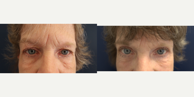 Eyelid Surgery before and after photo