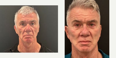 Eyelid Surgery before and after photo