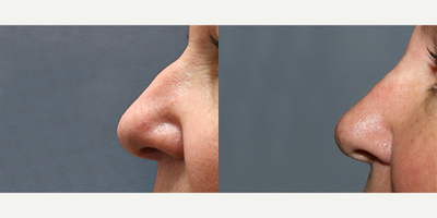 Restylane before and after photo