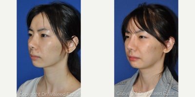 Revision Rhinoplasty before and after photo