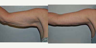 Arm Lift before and after photo