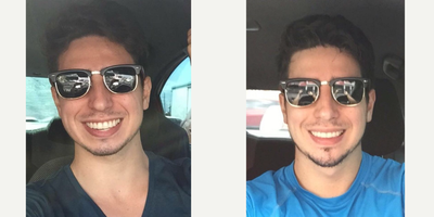 Chin Implant before and after photo