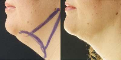 Chin Liposuction before and after photo