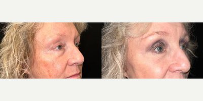 Eyelid Surgery before and after photo
