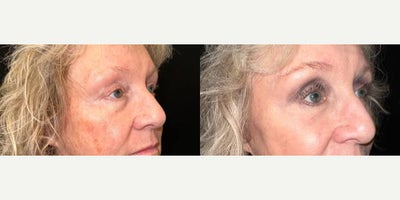 Eyelid Surgery before and after photo