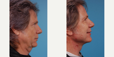 Facelift before and after photo
