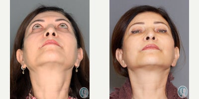 before and after image