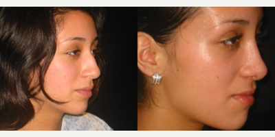 Rhinoplasty before and after photo