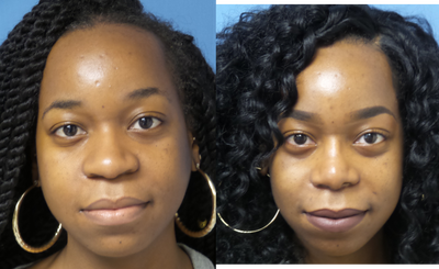 African American Rhinoplasty before and after photo