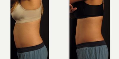 CoolSculpting before and after photo