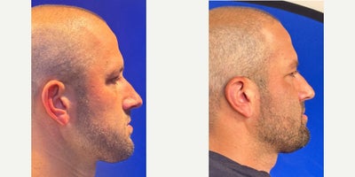 Ear Surgery before and after photo