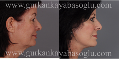 Facelift before and after photo