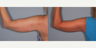 Liposculpture before and after photo