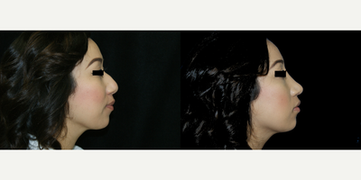 Rhinoplasty before and after photo