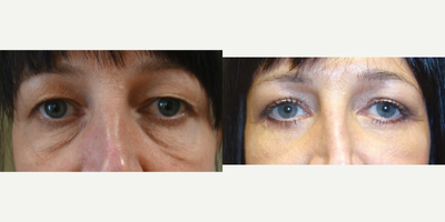 Eyelid Surgery before and after photo