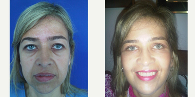 Facelift before and after photo