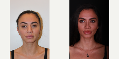 Rhinoplasty before and after photo