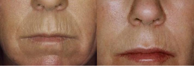 Collagen Injection before and after photo