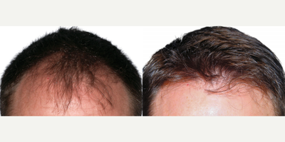 ARTAS Robotic Hair Transplant before and after photo