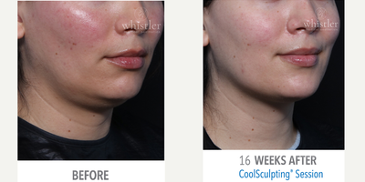CoolMini before and after photo