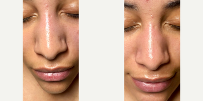 Facial before and after photo