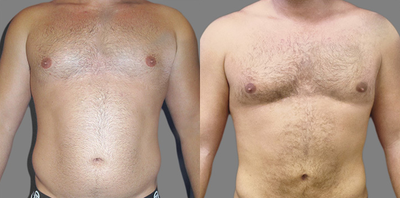 Liposuction before and after photo