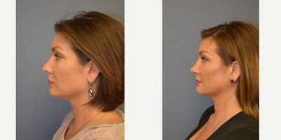 Rhinoplasty before and after photo