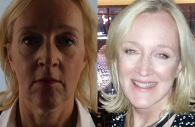 SMAS Facelift before and after photo