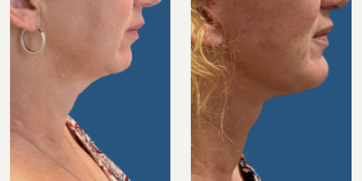 Chin Liposuction before and after photo
