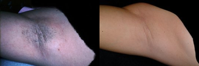 Laser Hair Removal before and after photo